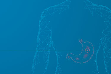 Cirurgia Bariátrica no HCI - HCI