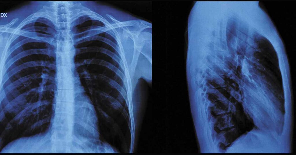 Raio X do tórax: identificando infecções e inflamações